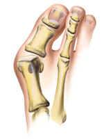 Dealing with Bunion Pain Houston or Considering Hammertoe Surgery Houston? Read This